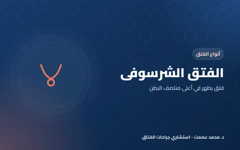 الفتق الشرسوفي