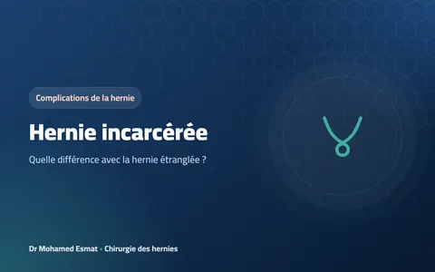 Hernie incarcérée : quelle différence avec la hernie étranglée ?
